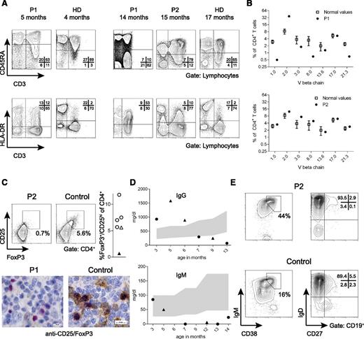 Figure 2. Evolution of basic immunologic parameters over time. (A) CD45RA+ T cells (upper row) and HLA-DR+ T cells (lower row) of P1 at the age of 5 months (uncontrolled CMV infection, beginning eczema) and 14 months (severe erythroderma) compared with T cells from the brother at the age of 15 months (uncontrolled CMV infection, no eczema). Plots from age-matched controls (HD) are shown in comparison. (B) TCRVβ usage among CD4+ T cells as assessed by flow cytometry using TCRVβ-specific antibodies. The percentage of CD4+ T cells expressing the individual TCRVβ chain is shown for P1 and P2 compared with reference values.28 (C) Staining for FoxP3+/CD25+ regulatory T cells in PBMC of P2 and a healthy control. The right panel shows the fraction of regulatory T cells in the day control (open triangle), the patient (black triangle), and 4 age-matched healthy infants (open circles). Below: CD25/FoxP3 stain of a lymph node biopsy from P1 and a control (FoxP3: red; CD25: brown). (D) Serum immunoglobulin levels over time in P1 (circles) and P2 (triangles). The shaded area represents normal values. (E) CD38+IgM+ transitional B cells (left) and IgD–CD27+ switched memory B cells (right) in P2 are shown compared with an age-matched healthy control.