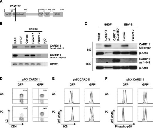 Figure 4. A non-sense mutation in the CARD11 gene is the cause of the T-cell activation defect. (A) Model of the CARD11 gene illustrating the site of the mutation in P1 and P2. (B) real-time PCR for the detection of CARD11 RNA isolated from bone marrow mononuclear cells. Amplicons spanning the 5′ and the 3′ ends of CARD11 cDNA. RAJI cells served as a positive control, NHDF as a negative control for CARD11 expression. HPRT cDNA amplification was used to prove cDNA integrity. (C) Immunoblot for detection of CARD11 proteins. Lysates of CARD11-deficient NHDF cells transfected with expression plasmids for WT or the mutant p.Cys150* CARD11 as well as Epstein-Barr virus lymphoblastic cell lines from P2 and a healthy donor were probed for CARD11. The antibodies recognized full-length protein (upper row) or the truncated CARD11 protein (third row). 20 µg protein was loaded for each lane except for NHDF/CARD11 WT (only 1 µg protein loaded). β-Actin was probed as loading control. (D) T cells of P2 and a healthy control were purified, transduced with WT CARD11 by retroviral transfection with pMX-CARD11-IRES-GFP, and tested for expression of IL-2 4 hours after stimulation with PMA/ionomycin. The gates were set on GFP– cells (no transfection) and GFP+ cells (transfection). (E-F) IκB degradation and p65 phosphorylation in retrovirally transduced T cells was measured after stimulation with PMA/ionomycin for 15 minutes (black line). The gray area represents unstimulated cells. All transfection experiments were repeated at least twice with similar results.