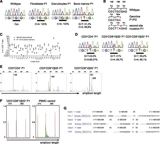 Figure 5. A somatic second-site mutation in the T-cell compartment is associated with oligoclonal expansion of T cells. (A) Quantitative sequence analysis of the CARD11 gene from the indicated cell populations. Percentages indicate the frequency of the mutated allele (Mutation Surveyor DNA Variant Analysis software). (B) Alterations of the CARD11 sequence and its consequences on protein level are shown. (C) TCRVβ usage among CD8+ T cells in the bone marrow as assessed by flow cytometry using TCRVβ chain-specific antibodies. The percentage of CD8+ T cells expressing the indicated TCRVβ chain is shown for P1 compared with reference values.28 (D) The indicated T-cell populations were purified from bone marrow of P1 by FACS sorting (>95% purity) for quantitative sequence analysis as in (A). (E) TCRγ rearrangement analysis of CD4+, CD8+/Vβ20+, and CD8+/Vβ20– T cells isolated from bone marrow of P1 using primers for Vγ1-8 (blue) and Vγ10 (black). Amplicon length (in bp) is plotted against the fluorescence intensity (arbitrary units). Size standards are indicated in orange. (F) Vβ20-specific primers were used to amplify the Vβ region of FACS-sorted CD8+/Vβ20+ T cells (left) and PBMC from a healthy control (right). (G) PCR products from (F) were sequenced and V(D)J junction sequences were analyzed with IMGT/V-Quest (imgt.org).