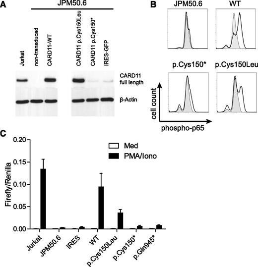 Figure 6. Somatic second-site mutation restores CARD11 expression and NF-κB signaling in patient T cells and Jurkat cell line. CARD11-deficient JPM50.6 cells were reconstituted with the indicated alleles of CARD11 by retroviral transduction with pMX-CARD11-IRES-GFP. GFP+ cells were FACS-sorted and expanded. (A) Immunoblot analysis of CARD11 expression compared with expression of CARD11 in Jurkat cell lines and nontransduced JPM50.6 cells. The blot is representative of 2 independent experiments. (B) Phosphorylation of p65 after stimulation with PMA/ionomycin (black line). The shaded area represents unstimulated cells. The assay was repeated 3 times with similar results. (C) Jurkat, JPM50.6, and CARD11-transduced JPM50.6 cells were transiently transfected with a firefly reporter gene construct responsive to NF-κB and a Renilla reporter under control of a CMV promotor for normalization. Bars represent firefly activity normalized to Renilla activity after stimulation with PMA/ionomycin (black bars) and without stimulation (white bars). Pooled data of 3 independent experiments are shown.