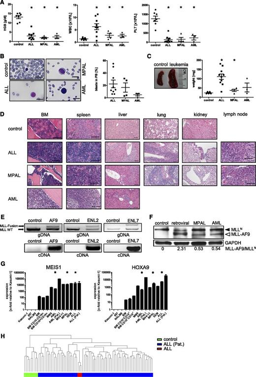Figure 4. Pathologic and molecular features of acute leukemias induced by genome editing of the MLL oncogene. (A) Plots show results of hematologic analyses performed on control (n = 7) and leukemic mice (n = 16), respectively. (B) Representative peripheral blood smears of control and leukemic mice are shown and summarized by calculating the percentage of blast cells (n = 16). Scale bars define 10 µm. (C) Spleen size and weight are shown for 1 representative control and leukemic mice (n = 17). (D) Hematoxylin-and-eosin–stained paraffin sections demonstrate disruption of organ architecture due to tumor infiltration compared with control mice. Scale bars define 100 µm. (E) PCR/RT-PCR was performed on gDNA and cDNA of leukemia cells to detect integration and expression of the MLL oncogenes and WT MLL gene. (F) Representative western blot analysis shows WT MLLN and MLL-AF9 expression in control (CD34+ cells nucleofected with template alone) and explanted blast cells from xenotransplants induced by either retroviral transduction or under the expression of the endogenous promoter (MPAL, AML). Glyceraldehyde-3-phosphate dehydrogenase (GAPDH), loading control. Bottom, relative MLL-AF9 band intensities compared with WT MLLN. (G) Representative qPCR analyses show elevated expression levels of MLL target genes compared with non-MLL leukemic cell lines or controls (human BM or BM CD10+/−/CD19+) but similar to cell lines and patients with MLL translocations. Representative results from 8 independent experiments are shown. (H) Unsupervised hierarchical cluster analysis of 3 leukemic mice (ALL) and 70 MLL-rearranged ALL patients showing similar gene expression profiling in contrast to control samples. Each dot (A-C) represents a mouse; horizontal bars represent the mean. *P < .05 was considered statistically significant. Error bars indicate SEM. HGB, hemoglobin; PB, peripheral blood; PLT, platelet; WBC, white blood cell.