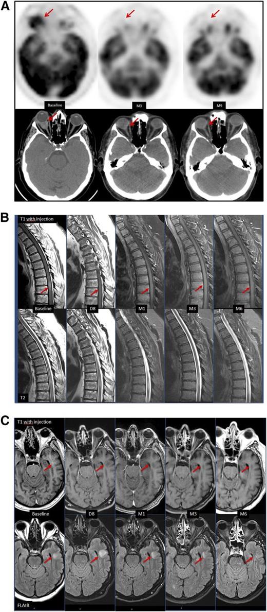 Figure 1. Neuroimaging in patient 1 and patient 2 under ibrutinib treatment. (A) Patient 1. CT without contrast and FDG-PET of the orbits at baseline, and at 3 and 9 months. Assessment at 3 months showed a CR. A clinical response was observed after 2 weeks of initiation of ibrutinib. (B-C) Patient 2. Contrast-enhanced T1-weighted (top) and T2-weighted (bottom) MRI of the spine (B), and contrast-enhanced T1-weighted (top) and FLAIR images (bottom) of the brain (C), at baseline, day 8, and at 1, 3, and 6 months. At day 8, CR was observed in the spine and the brain without remaining contrast enhancement. Anomalies on T2-weighted images took up to 6 months to clear in the brain.