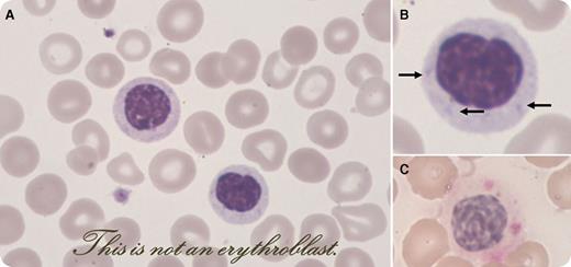 An 82-year-old woman was admitted for diffuse bone pain and deep asthenia. She was receiving erythropoietin for a refractory cytopenia with ring sideroblasts and thrombocytosis diagnosed 14 years before. A diagnosis of acute myeloid leukemia was made because of the presence of 22% myeloid blasts in the peripheral blood smear. We focused our attention on a frequent population (25%) of round-shaped nucleated cells with acidophilic cytoplasm that were identified at first glance as acidophilic erythroblasts (panel A). However, careful examination of these cells showed coarse nuclear chromatin resembling dysplastic polymorphs. Moreover, Döhle bodies were found in some of them (panel B, arrows), and weak myeloperoxidase activity was detectable in most of these cells (panel C). These observations allowed us to identify these cells as pseudo–Pelger-Huët neutrophils, associated with marked hypogranulation. We also used flow cytometry to confirm the absence of erythroblasts with CD36/CD71 staining of living cells. The cytogenetic examination showed a complex karyotype associated with a 17p− deletion, which is associated with small pseudo–Pelger-Huët neutrophils with round nuclei. / This observation illustrates how dysplastic cells might be difficult to recognize and should warn us about “the treachery of images” that René Magritte (1898-1967) highlighted with his famous painting representing a pipe and the inscription “This is not a pipe.”