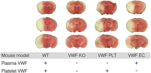 Platelet-derived VWF mediates ischemic stroke injury. This figure shows representative coronal brain sections 24 hours after induction of transient middle cerebral artery occlusion in wild-type mice (WT), mice completely lacking VWF (VWF KO), mice expressing VWF only in platelets (VWF PLT), and mice expressing VWF only in endothelial cells (VWF EC). White indicates areas of infarct; pink shows unaffected brain tissue. This figure has been modified from Figure 4A in the article by Verhenne et al that begins on page 1715. Professional illustration by Luk Cox, Somersault18:24.
