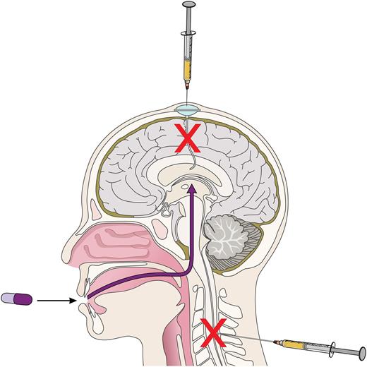 Different routes of CNS-directed therapies in MCL. Among patients with MCL, the average survival following development of CNS involvement is typically <6 months, despite treatment with intravenous and intrathecal chemotherapy. Bernard et al describe 3 cases of CNS MCL with ongoing remissions at 2 months, 9 months, and 1 year. Professional illustration by Patrick Lane, ScEYEnce Studios.