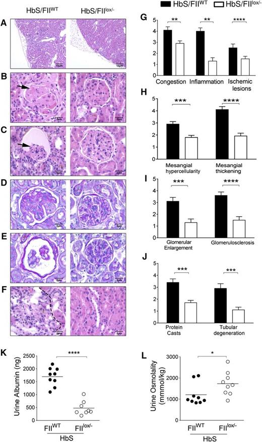 Figure 4. Sickle chimeras with low FII levels are protected against kidney damage and sickle nephropathy. (A-F) Representative H&E kidney sections comparisons between HbS/FIIWT (left panel) and HbS/FIIlox/− (right panel) mice showing (A) ischemia, inflammatory cell infiltration, and renal scarring (×10 objective). (B-C) FSGS and glomerular atrophy (shown by arrows) in HbS/FIIWT glomeruli compared with HbS/FIIlox/− glomeruli. (D-E) PAS staining showing glomerular basement membrane thickening in HbS/FIIWT glomeruli compared with HbS/FIIlox/− glomeruli. (F) Representative H&E-stained sections of renal tubules showing tubular loss, inflammatory cell infiltration (indicated by dotted lines), and regenerative tubules. (B-F) Objective, ×60. (G-J) Semiquantitative assessment of histologic features. Histology scores ranged from 0 to 5, where 0 represented normal kidney morphology; 1, changes in <15% of glomerular area; 2, 20% to 30% of the glomerular area; 3, 40% to 50% of the glomerular area; 4, ∼60% to 70% of glomerular area; 5, severe changes in most all glomeruli. (K) Urine albumin and (L) urine osmolality values. Mice used as transplant recipients were of similar ages (8-10 weeks) with equal numbers of males and females distributed among the experimental groups. Fully chimeric sickle or normal mice were followed for a year posttransplantation. Each symbol represents an individual animal. Statistical analyses on the histologic scores were done by Mann-Whitney U test. Statistical significance between HbS/FIIWT (n = 6) and HbS/FIIlox/− (n = 7) mice is indicated by asterisks: ****P < .0001, ***P < .01, **P < .01, *P < .05.
