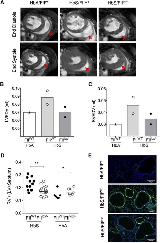 Figure 5. Sickle chimeras with genetically reduced FII levels have improved cardiopulmonary pathology and function. (A) CMR on representative HbA/FIIWT, HbS/FIIWT, and HbS/FIIlox/− mice at 1 year following bone marrow transplantation. A representative view of the ventricles is shown with RV in the same plane, which is indicated by the red arrows. (B-C) LV and RV end-diastole volumes in chimeric mice; symbols represent the value of each individual mouse and the bars denote the average. (D) RV hypertrophy is measured as a ratio of RV wall weight/LV + septum weights (Fulton Index) in HbS/FIIWT (n = 12), HbS/FIIlox/− (n = 15), HbA/FIIWT (n = 6), HbA/FIIlox/− (n = 7) mice. Cohorts were analyzed by Mann-Whitney U test. Statistical significance between FIIWT and FIIlox/− chimeras is indicated by asterisks: **P < .01, *P < .05. (E) α-SMA staining in lung tissue. Images are representative of 5 to 7 mice per group. Mice used as transplant recipients were of similar ages (8-10 weeks) with equal numbers of males and females distributed among the experimental groups. Fully chimeric sickle or normal mice were followed for a year after transplantation.