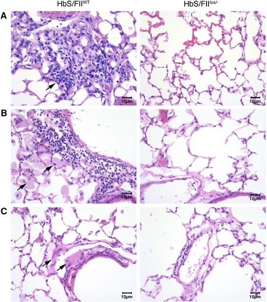 Figure 6. Sickle chimeras with 10% of normal FII levels have diminished pulmonary pathology. (A-C) Representative lung sections of HbS/FIIWT mice (left panels) compared with that of HbS/FIIlox/− mice (right panels) showing: (A) increased inflammatory infiltrate in HbS/FIIWT lungs compared with HbS/FIIlox/− lungs. Objective, ×10. (B) Increased alveolar macrophages in HbS/FIIWT lungs compared with HbS/FIIlox/− lungs. Objective, ×40. (C) Increased edema around blood vessels in HbS/FIIWT lungs vs its lack in HbS/FIIlox/− lungs. Objective, ×40. Black arrows indicate the pathology described in each panel. Images are representative of 6 to 9 mice per experimental group. Mice used as transplant recipients were of similar ages (8-10 weeks) with equal numbers of males and females distributed among the experimental groups. Fully chimeric sickle or normal mice were followed for a year posttransplantation.