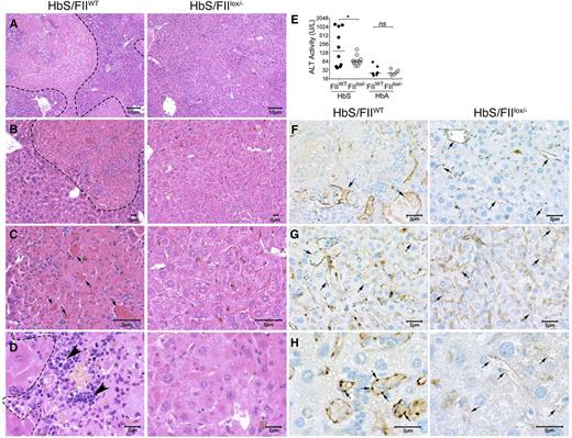 Figure 7. Sickle chimeras with genetically reduced FII levels have improved hepatic morphology, function, and reduced vascular occlusions. Representative H&E liver sections from HbS/FIIWT (left panel, A-D) and HbS/FIIlox/− (right panel, A-D) mice 1 year following marrow transplant viewed at various magnifications (objectives: A, ×10; B, ×20; C, ×40; and D, ×60) showing multifocal areas of coagulative hepatic necrosis with occasionally associated massively congested blood vessels (shown by arrows in panel C) in HbS/FIIWT mice. Areas of necrosis are marked by dotted lines (A-B,D) and infiltrating leukocytes are marked by arrowheads (D) in HbS/FIIWT mice. In HbS/FIIlox/− mice, the areas of coagulative necrosis were minimal with comparatively fewer congested blood vessels seen. (F-H) CD31 staining of liver vascular endothelial cells showing vascular congestion in HbS/FIIWT mice (shown by arrows) along with prominent rounded endothelial cells (H). These changes were minimal in HbS/FIIlox/− mice. No differences were observed in the microvascular density (MVD) in liver sections from HbA/FIIWT and HbA/FIIlox/− mice. (F-G) Objective, ×40. (H) Objective, ×100. Images are representative of 9 mice per experimental group. (E) Alanine transaminase (ALT) activity in the serum of HbS/FIIWT, HbS/FIIlox/−, HbA/FIIWT, and HbS/FIIlox/− mice. Each symbol represents an individual animal and lines represent median values. Mice used as transplant recipients were of similar ages (8-10 weeks) with equal numbers of males and females distributed among the experimental groups. Fully chimeric sickle or normal mice were followed for a year after transplantation. Cohorts were analyzed by Mann-Whitney U test and statistical significance between FIIWT and FIIlox/− chimeras is indicated by asterisks: *P < .05. n.s., not significant.