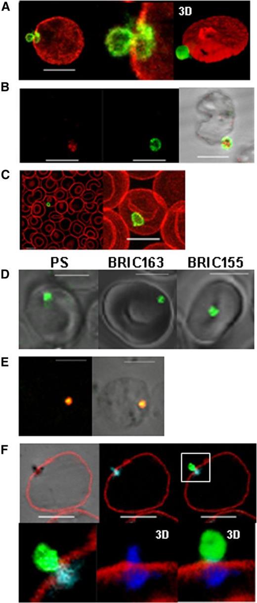 Figure 1. Release of PS-exposed, inside-out autophagic vesicles is a normal mechanism of reticulocyte maturation. (A) Trypsin-treated in vitro produced reticulocytes were fixed and stained with an anti–trypsin-insensitive GPA antibody (red, BRIC 256) before permeabilization, and then an anti–trypsin-sensitive GPA antibody after permeabilization (green, R10), shown with higher magnification and 3D reconstruction using Volocity software (Perkin Elmer, Waltham, MA). (B) Trypsin-treated in vitro-produced reticulocytes were fixed and stained for trypsin-insensitive GPA (green, R10) and autophagic marker LC3 (red). (C) Trypsin-treated red cells from peripheral blood stained as in (A). Shown in merge and magnification of a maximum projection. (D) Live imaging of in vitro-produced reticulocytes stained for PS, intracellular GPA (BRIC163), and intracellular AE1 (BRIC155) (all green). (E) Fixed and permeabilized in vitro-produced reticulocytes stained for PS (green) and giantin (red). Staining is shown in fluorescence and phase overlay. (F) Fixed unpermeabilized in vitro-produced reticulocytes stained for extracellular AE1 (red, BRAC18) and intracellular GPA (green, BRIC163) followed by Mitotracker (blue) staining post-permeabilization. Shown is a composite of a 2D slice in phase, fluorescence, and overlay images, and 3D reconstructions of the vesicle using Volocity software. All scale bars are 5 µm.