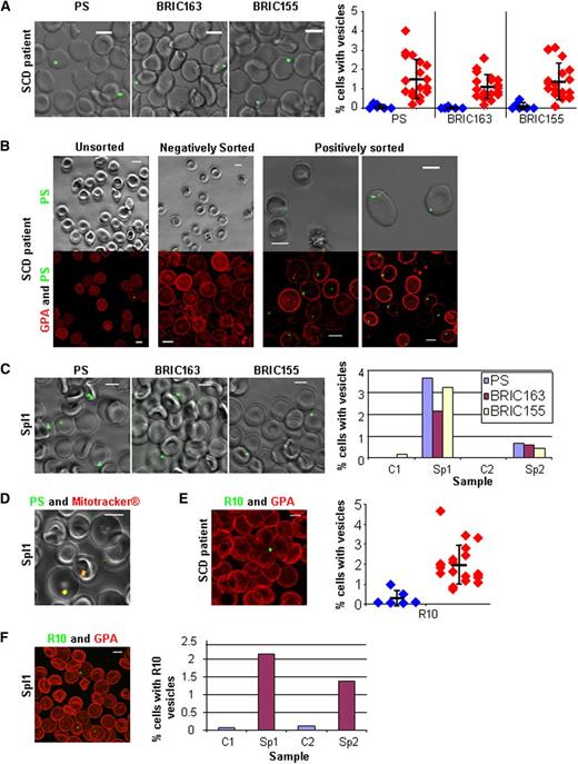 Figure 2. PS-exposed autophagic vesicles on red cells from peripheral blood in SCD and after splenectomy. (A) Live imaging of SCD red cells for PS, intracellular GPA (BRIC163), and intracellular AE1 (BRIC155); all green with quantitation from 20 SCD patients (red) and 8 controls (blue) imaging 5 random fields (average n = 439 per field), the thick horizontal line is the mean and standard deviation (SD) from the mean is shown. (B) Live imaging of SCD red cells after sorting for PS (green). Shown in phase overlay (upper panel) and as a 3D reconstruction (lower panel) dual-stained with GPA-546 (BRIC256) (red). (C) Live imaging of splenectomized patient 1 (Spl1, 3 years post-splenectomy) red cells for PS, intracellular GPA (BRIC163), and intracellular AE1 (BRIC155) (all green) with quantitation of Spl1 and splenectomized patient 2 (Spl2, 6 months post-splenectomy) imaging 5 random fields (average n = 375 per field). (D) Live imaging of red cells from Sp1 dual-stained with PS (green) and Mitotracker (red). (E) SCD red cells trypsin treated then fixed, permeabilized, and stained with R10 vesicles (green) and extracellular GPA (red) with quantitation from 20 SCD patients (red) and 8 controls (blue) imaging 5 random fields (average n = 381 per field), the thick horizontal line is the mean and SD from the mean is shown. (F) Spl1 red cells trypsin treated then fixed, permeabilized, and stained with R10 vesicles (green) and extracellular GPA (red) with quantitation from Spl1 and Spl2 with 2 controls imaging 5 random fields (average n = 280 per field). All scale bars are 5 µm.