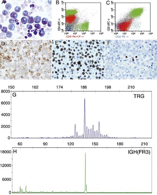 An 80-year-old HIV-negative man was found to have a large right pleural effusion. Cytology smears (panel A, Diff-Quik) showed numerous large atypical lymphoid cells with plasmablastic features. Flow cytometry showed these atypical cells were dimly positive for CD4 (panel B) but negative for the rest of the T-cell (panels B, C) and B-cell antigens (data not shown). Immunohistochemistry using the cell block showed the atypical cells were positive for CD4 (panel D), Kaposi sarcoma herpesvirus (KSHV) (panel E), and Epstein-Barr virus (in situ hybridization) but negative for the rest of the T-cell antigens and all B-cell antigens including octamer binding protein 2 (panel F and data not shown). Polymerase chain reaction analyses showed monoclonal TRG (panel G) and IGH (framework 3) (panel H) rearrangements. Of note, there was a single peak with little or no polyclonal background observed in the IGH assay. Based on the aforementioned findings, a primary effusion lymphoma (PEL) of T cells was diagnosed. / PEL is a body cavity–based KSHV-driven aggressive lymphoma of B-cell origin in HIV-positive patients in the vast majority of cases. PELs of T cells have rarely been reported. The diagnostic pitfalls in this unique case include (1) lack of T-cell–specific and T-cell–associated antigens (except CD4) and (2) the presence of IGH pseudo-monoclonality due to extremely low numbers of B cells.