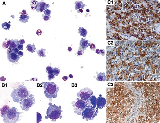 A 4-year-old boy presented with 3 weeks of right-sided knee pain and difficulty walking. On examination, a decrease in right hip abduction was noted without erythema, swelling, fluctuance, or warmth of the right hip or knee. Radiographic studies demonstrated a 4-cm poorly marginated lesion in the right supraacetabular region that was biopsied. Cytospin preparations of the biopsy showed numerous abnormal histiocytic cells admixed with eosinophils, small lymphocytes, and macrophages (panel A). The histiocytic cells showed prominent dendritic projections (panel B1), cytoplasmic blebbing (panel B2), and folded nuclei (panel B3). Flow cytometry demonstrated an atypical population expressing bright CD1a, CD4, CD13, CD33, CD14, CD64, and HLA-DR. The diagnosis of Langerhans cell histiocytosis (LCH) was confirmed by histologic sections, which showed numerous histiocytic cells with grooved nuclei in an eosinophil-rich background. Immunohistostains were positive for CD1a (panel C1), Langerin (panel C2), and BRAF V600E (panel C3). / LCH is the most commonly diagnosed histiocytic neoplasm. Recent evidence suggests that LCH may arise from abnormal bone marrow-derived dendritic cell precursors that are driven by oncogenic mutations. The BRAF V600E mutation is present in ∼50% of cases. The diagnosis of LCH is based on detecting morphologically abnormal CD1a+ histiocytes in an eosinophil-rich background. Rarely, these diagnostic features are present in cytologic preparations combined with flow cytometry.