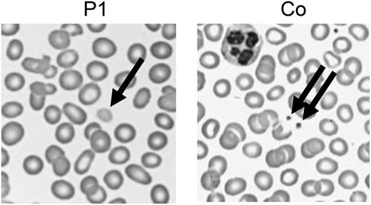 Figure 1. Enlarged platelets. Representative images of a routine peripheral blood smear showing enlarged pale platelets in P1. Co, control.