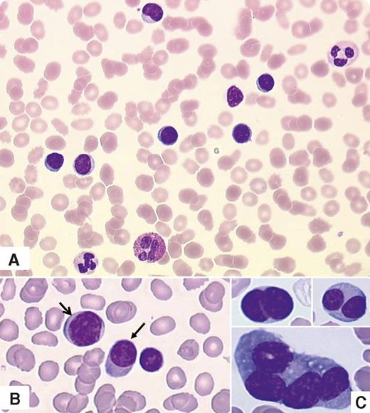 A 79-year-old woman was admitted for severe renal failure, hyperkalemia, hypercalcemia, fatigue, and nausea. She had a 7-year history of monoclonal gammopathy of undetermined significance with immunoparesis and osteoporosis. Complete blood count revealed leukocytosis (33 × 109/L) characterized as lymphocytosis by the analyzer (80%), thrombopenia (90 × 109/L), and anemia (11 g/dL) without neutropenia. Careful examination of blood smears revealed mature small cells, with round nuclei and a high nuclear-cytoplasmic ratio associated with erythrocyte rouleaux (panel A). She had a serum immunoglobulin G-κ level of 6.2 g/L. Flow cytometry diagnosed plasma cell leukemia, showing 70% of nucleated cells expressing bright CD138 and CD38, CD20 without CD19, CD56/CD28 or CD45, and monotypic cytoplasmic κ light chains. This prompted a more thorough examination of the peripheral cells. Some of the small cells had plasma cell features with a perinuclear hof and sometimes an eccentric nucleus (arrows in panel B). Pleomorphic plasma cells were observed on bone marrow smears (giant, multinucleated; panel C). Further exploration showed both a del17p and a p53 mutation. / The patient received 8 cycles of bortezomib (Velcade)/cyclophosphamide/dexamethasone and relapsed 18 months later, again with peripheral lymphoplasmacytic infiltration mistaken for lymphocytes by the analyzer. This case emphasizes the need to review the blood smear in patients with markedly abnormal values or a suspected hematologic disorder.