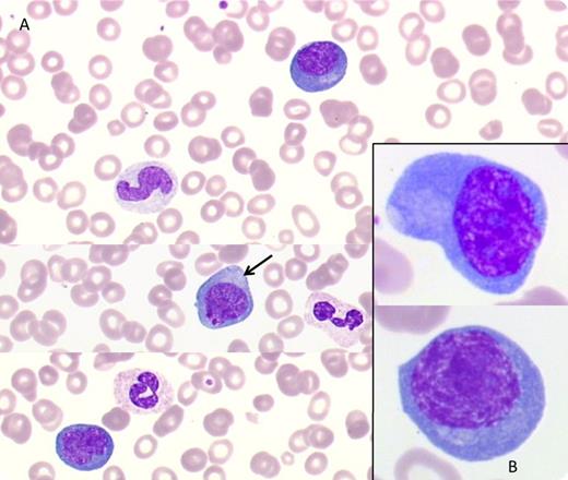 A 60-year-old woman with an 8-year history of HIV infection was admitted for cough and fever. A visceral and cutaneous Kaposi sarcoma diagnosed 2 years previously was in partial response (PR) after doxorubicin. Chest and abdomen computed tomography scan revealed diffuse adenopathy and splenomegaly, felt to be inconsistent with the Kaposi sarcoma PR. Blood count showed anemia at 102 g/L, thrombopenia (90 × 109/L), leukocytosis (13.73 × 109/L), and lymphocytosis (4.26 × 109/L) with 0.394 × 109/L CD4+ T cells. An HIV viral load test was negative. / Peripheral blood smears showed large activated cells with nuclei containing 1 to 2 prominent nucleoli and abundant basophilic cytoplasm (panel A, ×40; panel B, ×100, May-Grünwald-Giemsa stain). Flow cytometry disclosed 12% of nucleated cells with high side scatter, CD19+, CD38+, surface λ light-chain restriction, lacking CD20, CD22, and CD138. This clonal B-cell proliferation suggested a diagnosis of multicentric Castleman disease in leukemic phase confirmed by the evidence of human herpesvirus 8/Kaposi sarcoma associated herpes virus (HHV8/KSHV) viral load test positive, demonstration of cytoplasmic hofs (panel A, arrow), and pathology. Treatment with cyclophosphamide, vincristine, and prednisone and with rituximab combined with low-dose cyclophosphamide, doxorubicin, vincristine, and prednisone improved the patient’s condition. Rarely occurring HHV8-positive plasmablastic lymphoma involves lymph nodes, spleen, and other viscera but seldom manifests as leukemia. This case stresses the importance of performing immunophenotyping in immunosuppressed patients where such cells could be mistaken for activated T lymphocytes.