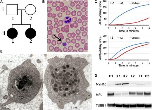 Figure 1. Autosomal recessive inheritance of a platelet phenotype that mimics Paris-Trousseau thrombocytopenia. (A) Pedigree of the consanguineous family with the probands in black. (B) MGG stained blood film showing a normal sized platelet (thin arrow) and giant platelet (thick arrow). (C) Platelet aggregation measured by Multiplate in homozygous R324W FLI1 blood (top, II.2) and heterozygous R324W FLI1 (bottom, I.1) in response to arachidonic acid (AA) in blue and collagen in red. (D) Western blotting using monoclonal antibodies against MYH10 (mouse monoclonal, clone A-3) and MPL (rabbit polyclonal), with tubulin (mouse monoclonal, clone SAP.4G5) used as protein loading control, on probands (II.1 and II.2), their parents (I.1 and I.2), and unrelated controls (C1, C2). (E) Photographs of II.1 platelet EM demonstrating α-granule defect characteristic of Paris-Trousseau thrombocytopenia on the left compared with a platelet with normal granule appearance on the right.
