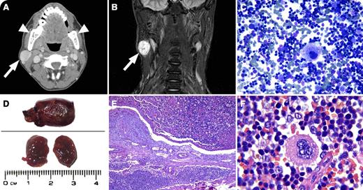 A 24-year-old regularly transfused patient with β-thalassemia major presented with a lateral neck mass. Computed tomography and magnetic resonance imaging showed an enhanced mass 2.3 × 2 × 2.2 cm in the right parotid gland (panels A-B, arrows) with expansion and coarsening of the bony parts (panel A, arrowheads). Differential diagnosis included salivary gland tumors, metastases, hematomas, hemangioma, and extramedullary hematopoiesis (EMH). Fine-needle aspiration of the mass showed normal bone marrow elements (panel C), and EMH was suggested. Pathology showed a soft, dark red, clot-like mass (panel D) that was confirmed as nodal EMH (panels E-F). / EMH and bone changes are well established in β-thalassemia. EMH is primarily seen in untreated or inadequately treated patients with thalassemia major or thalassemia intermedia and may not be prevented even by hypertransfusion regimens,whereas it is very rare in patients with thalassemia major who have received the appropriate treatment. Although EMH is usually primarily restricted to the liver or spleen, soft-tissue masses of EMH are rare. Biopsy is indicated when EMH occurs in very rare and unusual locations to exclude other differential diagnoses. If EMH is in a typical location and is not causing clinical problems, close monitoring without biopsy, in addition to attempts to suppress ineffective erythropoiesis or increase its efficacy, may suffice.