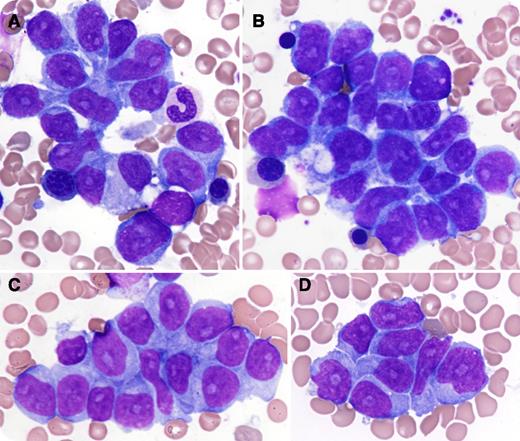 A 22-year-old man with no remarkable medical history presented with sweating and fatigue. His examination revealed hepatosplenomegaly with mild isolated thrombocytopenia (107 × 109/L). His leukocyte count was 8.5 × 109/L, without abnormal circulating cells, and his hemoglobin level was 13.1 g/dL. The remaining biological analyses were normal except for an elevated lactate dehydrogenase level (835 IU/L, normal <250 IU/L). The bone marrow aspirate showed infiltration of monomorphic, medium- to large-sized cells that were most often gathered in clusters rather than seldom isolated. The cells displayed regular and irregular nucleus outline; intermediate chromatin, sometimes blastic with prominent nucleoli; and a slight to moderately abundant amount of basophilic cytoplasm (panels A-D). / This cytomorphologic appearance looked consistent with metastatic cells. However, the immunophenotypic analysis revealed that these cells belong to T lineage showing expression of γ-δ T-cell receptors with CD3, CD2, CD56, CD16, CD11b, and weak CD7 expression, but no CD5, CD4, or CD8 expression. The examination of the bone marrow biopsy showed only intrasinusoidal involvement of these lymphoma cells, which were positive for T-cell intracellular antigen-1 but negative for granzyme B and perforin. The karyotype was normal. The molecular exploration detected a γ-δ T clone. We report here an unusual presentation of hepatosplenic T-cell lymphoma mimicking bone marrow metastasis. The presence of a blastic component does not rule out this diagnosis.