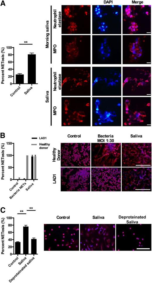 Figure 1. Saliva induces NETs in the oral cavity. Immunofluorescence microscopy was performed with staining for DNA (DAPI, blue) and for elastase and MPO (both red). All images were acquired using a Nikon Eclipse TE200 equipped with a Hamamatsu C4742-95 CCD camera, using Plan Apochromat 20× and 100× objectives and NIS-elements 3.1 (Nikon) software was used for image acquisition and processing. All images for all figures were acquired and formatted in the same fashion unless stated otherwise. (A) Immunofluorescence microscopy of neutrophils collected from morning saliva demonstrated the presence of NETs judged from presence of extracellular DNA with bound elastase and MPO. Stimulation of neutrophils with saliva caused similar NET formation. The presence of NETS in morning saliva were investigated in 6 donors (5 nonsmokers and 1 smoker) with no systemic disease or known oral or dental disease. NETs were found in all donors with no apparent difference between the smoker and the nonsmokers. Scale bars represent 10 μm. (B) Neutrophils from a 13-month-old patient with LAD1 and a healthy control were stimulated for 1 hour with either saliva or S. aureus or left nonstimulated in RPMI 1640 with HSA. Scale bars denote 200 μm and the error bars denote the difference between 20 randomly selected images. Due to the lack of integrins the neutrophils in this experiment are not stimulated on coverslips but in solution. This gives a lower amount of NETosis in the nonstimulated neutrophils compared with the other experiments in which the neutrophils adhere to coverslips before stimulation. (C) Neutrophils were stimulated with saliva or protein-free saliva. Results from 3 independent experiments are shown (in A and C). Detailed statistical analyses for all figures are included in supplementary Appendix A. Scale bars, 100 μm. **P < .01, columns denote average values and error bars denote standard deviations.