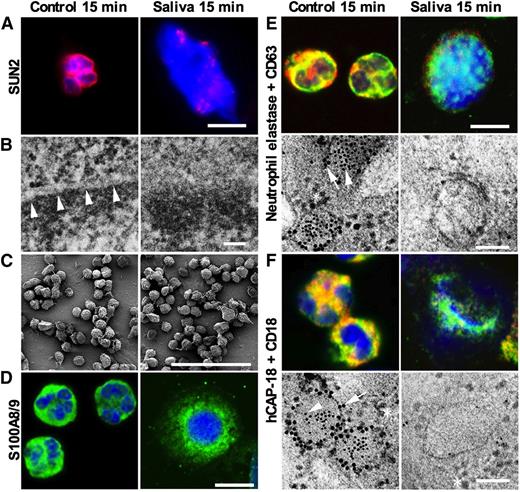 Figure 4. Intracellular event during saliva-induced NETosis. Neutrophils were left nontreated or were stimulated with saliva for 15 minutes and examined by immunofluorescence microscopy and electron microscopy. All fluorescence micrographs were acquired with a Zeiss LSM700 Axioimager M2 equipped with a 4-stack laser system (−405, −488, −555, −635 nm wavelength) using Zen (Zeiss) software, with a 63× oil immersion objective. Electron micrographs were acquired using a JEOL JEM 1230 transmission electron microscope and a JEOL JSM-350 scanning electron microscope with a secondary detector. (A) Immunofluorescence microscopy shows that staining for SUN2 found in the nuclear membrane is dramatically changed after 15 minutes stimulation by saliva. Scale bars represent 10 μm. (B) Transmission electron microscopy demonstrating that the nuclear membrane is lost after stimulation by saliva. Arrow heads indicate nuclear membrane. Scale bars, 50 nm. Larger images found in supplementary Figure 5. (C) Scanning electron microscopy of neutrophils demonstrating no visible changes in the plasma membrane after 15 minutes of saliva stimulation. Scale bars, 100 μm. Larger images found in supplementary Figure 4. (D) Confocal immunofluorescence microscopy for the cytosolic protein S100A8. Scale bars, 10 μm. (E) Confocal immunofluorescence microscopy and immunoelectron microscopy the azurophilic granule protein elastase (green or 5 nm gold particles) and CD63 (red or 10 nm gold particles) present in the azurophil granule membrane. Yellow color depicts colocalization. Many ribosomes of approximately the same size as the 10 nm gold particles are found around the granules in the electron micrograph. Arrow heads indicate elastase in the granule matrix and CD63 in the granule membrane. Scale bars, 10 μm for fluorescence micrographs and 100 nm for electron micrographs. (F) Confocal immunofluorescence microscopy and immunoelectron microscopy demonstrates the specific granule protein hCAP-18 (green or 5 nm gold particles) and CD18 (red or 10 nm gold particles) present in the membrane of specific granules. Yellow color depicts colocalization. Many ribosomes of approximately the same size as the 10 nm gold particles are found around the granules in the electron micrograph. Arrow heads indicate hCAP-18 in the granule matrix and CD18 in the granule membrane. Scale bars, 10 μm for fluorescence micrographs and 100 nm for electron micrographs.