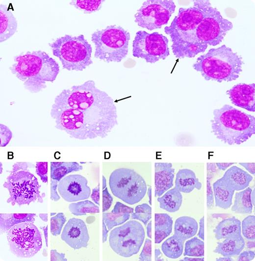 A 72-year-old man presented in an acutely confused state. He had been diagnosed with immunoglobulin A κ, 17p-deleted multiple myeloma (MM) 3 years prior. He had since received numerous lines of treatment, including several immunomodulatory agents (thalidomide, lenalidomide, pomalidomide) and proteasome inhibitors (bortezomib, carfilzomib). Because his initial workup was noncontributory to diagnosis, a lumbar puncture was performed. The cerebrospinal fluid (CSF) showed an elevated protein level and low glucose levels. Microscopic examination of the CSF revealed an infiltration by MM cells (panel A), confirmed by flow cytometry, including numerous binuclear (panel A, arrows) and dividing cells at all phases of mitosis; (panel B) prophase-chromatin condensation into chromosomes; (panel C) metaphase-chromosomes coiling in the middle of the cell; (panel D) anaphase-chromosomes splitting, and movement of sister chromatids to opposite poles; and (panel E) telophase-sister chromatids reaching opposite poles. Karyokinesis (nucleus division) was also observed, without completion of cellular division (panel F), a finding that might explain the generation of binucleated cells. / The incidence of extramedullary MM seems to be rising. Whether this reflects increased selective pressure by novel therapies or is simply a consequence of longer survival has yet to be determined. Our observation suggests that MM cells do not merely survive but also proliferate within the CSF, even in the absence of bone marrow microenvironmental support.