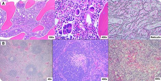 A 14-year-old white young man was transferred from an outside hospital with a 4-week history of fever, 30-lb weight gain, and diarrhea. He was noted to have anasarca, elevated C-reactive protein (CRP), elevated creatinine, anemia, and thrombocytopenia. A detailed clinical work-up for infectious and autoimmune etiologies was negative. Bone marrow biopsy showed a hypercellular marrow with megakaryocytic hyperplasia, clustering, and reticulin fibrosis (panel A, left to right). Ultrasound revealed enlarged lymph nodes that were fluorodeoxyglucose-avid by positron emission tomography–computed tomography scan. A right inguinal lymph node excisional biopsy (panel B, left to right) showed regressed germinal centers, expanded concentric mantle zones penetrated by hyalinized vessels, and vascular interfollicular areas that were consistent with idiopathic multicentric Castleman disease (iMCD). The overall clinicopathological picture was compatible with TAFRO syndrome (thrombocytopenia, anasarca, myelofibrosis/fever, renal dysfunction/reticulin fibrosis, and organomegaly) or Castleman-Kojima disease, a recently described variant of iMCD. In contrast to typical cases of iMCD, gamma globulin levels are normal and thrombocytopenia is a consistent feature. / The etiology of iMCD is unclear and is hypothesized to be a systemic inflammatory disorder mediated by redundant cytokines. The patient responded well to corticosteroids and siltuximab with prompt resolution of thrombocytopenia, ascites, and renal dysfunction and decrease in CRP and interleukin-6 levels.