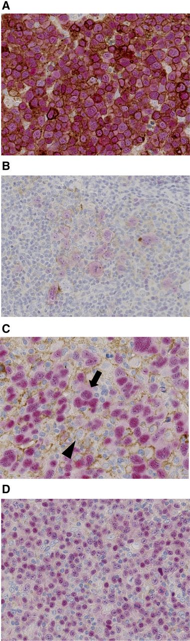 Figure 1. Representative immunohistochemical analysis of PD-L1 expression in DLBCL using a double-staining technique. (A) PD-L1+ DLBCL. Tumor cells were double positive for PD-L1 (brown) and PAX5 (red). Representative cases of (A) DLBCL NOS and (B) TCHRLBCL are presented. (C) mPD-L1+ DLBCL. Tumor cells (arrow) were positive for PAX5 and negative for PD-L1. PD-L1+ nonmalignant cells (arrowhead) represented 20% or more of the total tissue cellularity. (D) PD-L1– and mPD-L1– DLBCL. Tumor cells were positive for PAX5 and negative for PD-L1. Occasionally, PD-L1+ nonmalignant cells were identified; however, these represented less than 20% of the total tissue cellularity.