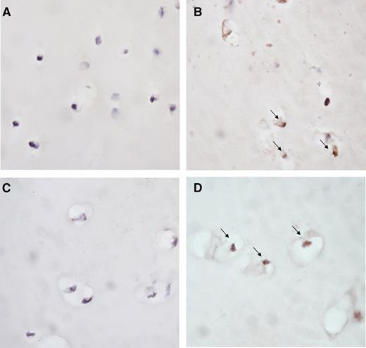 Figure 4. Blocking IL-1 limits blood-induced chondrocyte apoptosis. Representative photomicrographs of chondrocyte apoptosis in human articular cartilage explants cultured in medium (A) or exposed to 50% v/v whole blood (B-D) for 4 days. IL-1βmAb (C) or TNFαmAb (D) was added during blood exposure. Apoptosis of chondrocytes was determined by immunohistochemical staining with ssDNA (brown staining, indicated by arrow). Original magnification ×40.