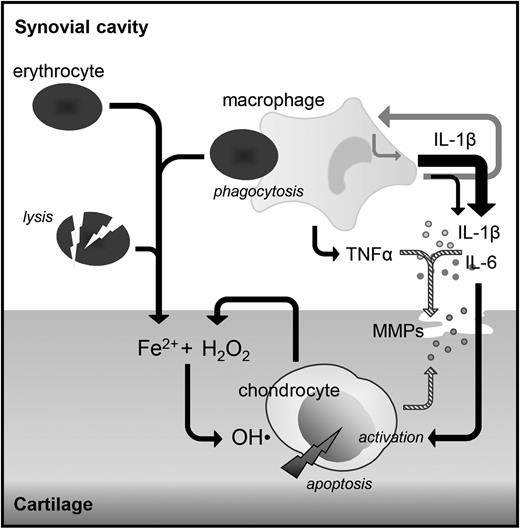 Figure 6. Suggested role of cytokines in the pathogenesis of synovial independent blood-induced cartilage damage. Monocyte/macrophages activated by the phagocytosis of erythrocytes produce IL-1β and TNFα, which both induce the production of proteases causing reversible cartilage damage (striped arrows). IL-1β also induces the production of IL-6 and IL-1β itself (gray arrows). These cytokines are able to activate the chondrocyte to produce hydrogen peroxide (H2O2), which in the presence of iron leads to the production of hydroxyl radicals (OH·) causing chondrocyte apoptosis and as such irreversible cartilage damage, whereas TNFα does not. Local inhibition of IL-1β (directly in case of major surgery) or within the same day (in case of trauma or hemophilia-induced joint bleeds) may provide a mechanism to prevent cartilage damage and with that joint destruction later on.