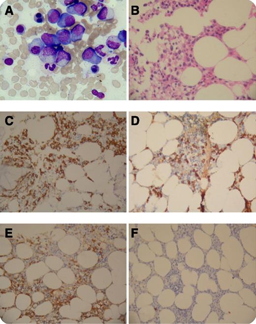 A 64-year-old woman presented to our institution for increasing neck pain without headache, dizziness, or blurred vision. Magnetic resonance imaging revealed an osteolytic lesion at the C6 vertebra with a compression fracture, as well as lymphadenopathy around the upper middle esophagus. She underwent C6 vertebral resection and local reconstruction, and the pathological findings indicated plasmacytoma with expression of CD20, CD79a, VS38C, CD138, and κ light chain. Serum immunofixation electrophoresis was positive for immunoglobulin G (IgG)-κ paraprotein with serum IgG4 surging to an astounding 4.88 g/dL. No anemia or renal insufficiency was found. Bone marrow smear (panel A) and biopsy (panel B) showed accumulation of mature and immature plasma cells up to 28.5%. Immunohistochemical study revealed membrane staining of CD138 (panel C) as well as cytoplasmic staining of IgG4 (panel D) among myeloma cells, which demonstrated κ (panel E) instead of λ (panel F) light chain restriction. / IgG4-related diseases (IgG4-RD) are characterized by chronic fibro-inflammatory lesions affecting multiple organs, which might be misinterpreted as neoplasm. Meanwhile, plasma cell neoplasms with monoclonal IgG4 production have seldom been described. The accumulation and neoplastic transformation of IgG4 secreting plasma cells in this patient seem not sufficient to induce any clinical manifestations mimicking IgG4-RD, which suggests that elevated IgG4 alone is not diagnostic for IgG4-RD.