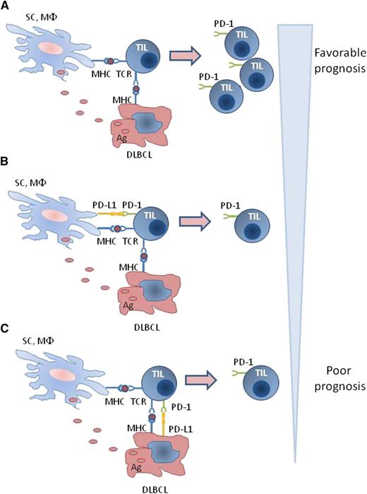 Regulation of PD-1 expression in T cells of the DLBCL microenvironment. (A) Direct and indirect antigen presentation by lymphoma cells and nonmalignant cells, respectively, in the absence of PD-L1 results in activation of TILs inducing expression of activation markers including PD-1 and expansion of PD-1+ TILs. (B-C) In the presence of PD-L1 on either DLBCL or nonmalignant cells, activation of TIL and expression of PD-1 are diminished, and expansion of PD-1+ TIL is inhibited. Ag, antigen; MHC, major histocompatibility complex; MΦ, macrophage; SC, stroma cell; TCR, T-cell receptor.