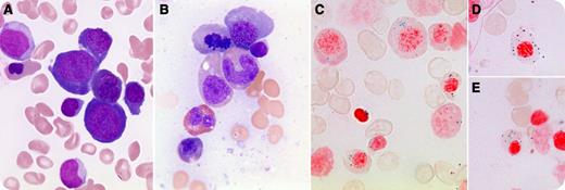 A 51-year-old white woman with a history of pernicious anemia developed increasing lethargy and shortness of breath without neurologic or B symptoms. Investigations revealed the following: white blood cells 2.8 × 109/L, hemoglobin 62 g/L (mean cell volume 126.3 fL), platelets 82 × 109/L, and evidence of hemolysis (unconjugated bilirubin 58 μmol/L, lactate dehydrogenase >2500 U/L, reticulocytes 45 × 109/L, and haptoglobin <0.07 g/L) with negative direct antiglobulin test. Red cell folate was normal, but total vitamin B12 level was decreased at <22 pmol/L; homocysteine and methylmalonic acid were elevated (21.5 μmol/L and 16.6 μmol/L, respectively). Peripheral blood film showed macrocytes and mild fragmented erythrocytes. Bone marrow (BM) aspirate revealed a hypercellular marrow with megaloblastic and dysplastic features in myeloid and erythroid lineages (panels A-B), along with 10% to 15% ring sideroblasts (panels C-E). Marrow cytogenetics revealed a normal female karyotype. / A month after receiving intramuscular vitamin B12 injections daily for 1 week, then weekly, the patient became asymptomatic. Her blood counts and vitamin B12 level normalized, thus arguing against an alternative diagnosis of myelodysplasia (BM aspirate was not repeated). This is a rare presentation of vitamin B12 deficiency with striking megaloblastic features and ring sideroblasts. Rather than presumptively diagnosing myelodysplasia, timely recognition and vitamin B12 supplementation lead to resolution of symptoms and blood work abnormalities.