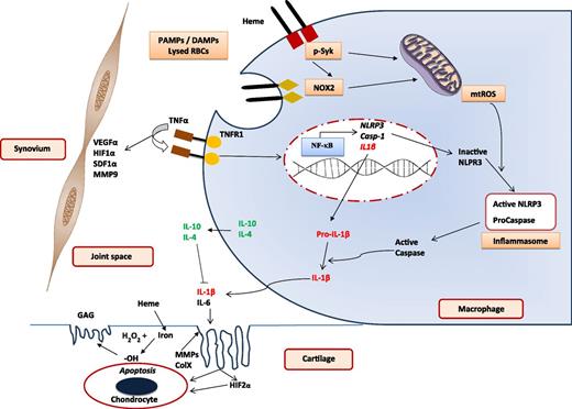 Blood-induced joint damage. Mechanisms involved in IL-1β–mediated inflammation, cartilage damage, and synovial reaction after exposure to blood. Various PAMPs or DAMPs prime macrophages to activate NF-κB and induce expression of NLRP3, caspase-1, and IL-1β. Heme induces Syk and NADPH oxidase 2 (NOX2) activation to generate mtROS required for activation of NLRP3 to create the inflammasome for generating active caspase-1. This in turn generates active IL-1β from the macrophage to initiate the inflammatory response leading to cartilage damage. Other cytokines promote (such as IL-6) and inhibit (such as IL-10 and IL-4) inflammation. A separate set of events, probably initiated by TNFα and mediated by VEGFα, HIFα, SDF1α, and MMP9, lead to synovial inflammation, hyperplasia, and neoangiogenesis. DAMP, distress-associated molecular pattern; GAG, glycosaminoglycan; HIF1α, hypoxia-inducible factor 1α; MMP9, matrix metalloprotease 9; mtROS, mitochondrial reactive oxygen species; NF-κB, nuclear factor-κB; PAMP, pathogen-associated molecular pattern; RBC, red blood cell; SDF1α, stromal cell-derived factor 1α; VEGFα, vascular endothelial growth factor α. The figure is based on Dutra et al,7 Schlesinger et al,9 Sen et al,11 and the article by van Vulpen et al beginning on page 2239.