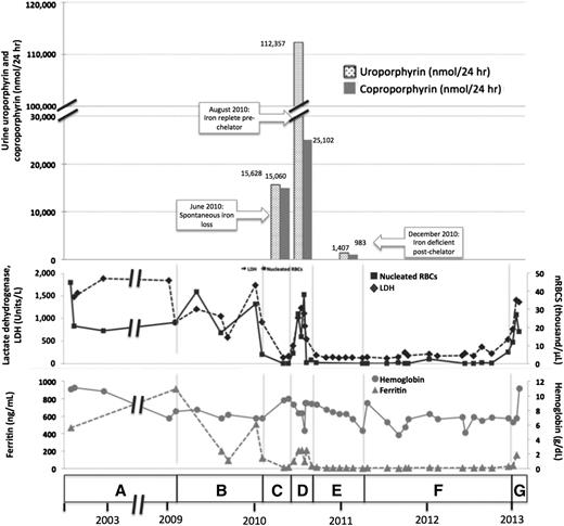 Figure 1. Correlation of clinical and laboratory findings in patient 1. (A) A female of Alaskan Native descent (patient 1) was diagnosed with CEP at 12 months of age after presenting with red urine, discolored teeth, and blisters. A younger sister (patient 2) would also later be diagnosed with CEP. Genetic testing revealed compound heterozygosity for previously described C73R and A104V mutations in UROS. Since childhood, disease complications included chronic hemolysis and severe photosensitivity with scarring, which were managed with sun avoidance and supportive measures including blood transfusions. Patient 1 underwent laparoscopic splenectomy in February 2002 at the age of 25 years. Baseline laboratory parameters include an LDH that ranged from 906 to 1885 U/L (reference range, 80-190 U/L), nucleated red blood cells (nRBCs) between 17.1 and 44.9 × 103 cells/μL (reference, 0.0 × 103 cells/μL), and a reticulocyte count of 195 billion cells/L (reference, 20-65 billion cells/L), reflecting chronic hemolysis. The hemoglobin level ranged from 6.9 to 10.9 g/dL (reference range, 11.5-15.5 g/dL), and the patient’s ferritin level was 470 ng/mL in 2002 (reference range, 10-180 ng/mL). Laboratory values are provided in detail in supplemental Table 1. (B) In February 2009, the ferritin level increased to 910 ng/mL as a result of blood transfusions. Deferasirox was administered to treat iron overload and was discontinued after ferritin level decreased to 93 ng/mL in September 2009. The ferritin level increased again to 508 ng/mL by January 2010. (C) In May 2010, a spontaneous reduction in serum ferritin level to 13 ng/mL was noted and was attributed to occult gastrointestinal (GI) bleeding. Concurrently, the patient reported a dramatic improvement in photosensitivity and a normalization in urine color. Markers of hemolysis also improved, as shown, with a reduction in LDH level to 138 U/L and a marked reduction in circulating nRBCs to 0.2 × 103 cells/μL. Hemoglobin level increased from 6.9 to 9.4. Reticulocyte count decreased to 55 billion cells/L (data not shown). Quantitative analysis of urine porphyrins demonstrated uroporphyrin at 15 628 nmol/24 hours and coproporphyrin at 15 060 nmol/24 hours. Prior values are not available for comparison, and full data regarding the porphyrin fractions are available in supplemental Table 2. (D) Resolution of GI bleeding was accompanied by a rise in serum ferritin level to 208 ng/mL and a concordant worsening of photosensitivity and darkening of urine color. Similarly, LDH level increased to 540 U/L, reticulocyte count increased markedly to 163 billion cells/L, and nRBCs increased to 4.3 × 103 cells/μL. Repeat quantitative analysis of urine porphyrins at this time demonstrated a significant increase in both uroporphyrin (112 357 nmol/24 hours) and coproporphyrin (25 102 nmol/24 hours). (E) In August 2010, based on the correlation between iron status, laboratory parameters, and photosensitivity, we initiated a trial of deferasirox to induce and maintain an iron-deficient state. Deferasirox was initially dosed at 500 mg daily and then in November 2010 was adjusted to 500 mg 3 times weekly to target a ferritin level range of 10 to 15 ng/mL. With deferasirox, the serum ferritin level dropped to 16 ng/mL over 2 months, and the patient again reported an improvement in her quality of life with reduced photosensitivity. As further evidence of the efficacy of deferasirox, an impressive reduction in uroporphyrin to 1470 nmol/24 hours and coproporphyrin to 983 nmol/24 hours was seen on repeat quantitative analysis of urine porphyrins 4 months after chelation began. In addition, total (unfractionated) urine porphyrins decreased from 108 364 μg/24 hours in June 2010 to 5896.3 μg/24 hours in December 2010. Concurrently, LDH normalized to a level of 135 U/L, reticulocyte count decreased to 47 billion/L, nRBCs remained between 0.14 and 0.68 × 103 cells/μL, and hemoglobin level remained between 6.8 and 9.0 g/dL without transfusional support. (F) In April 2011, patient 1 developed recurrent upper GI bleeding, deferasirox was discontinued, and red blood cell transfusions were administered. Over the ensuing 2 years, numerous repeat endoscopies showed persistent gastric erosions and ulcerations despite ongoing use of a proton pump inhibitor. As a result of the ongoing iron losses, ferritin level remained <15 ng/mL, and there was continued control of CEP symptoms and stabilization of laboratory markers of hemolysis. (G) In January 2013, the patient’s serum ferritin increased abruptly, consistent with resolution of GI bleeding. Her photosensitivity suddenly worsened, accompanied by a rise in LDH level to 1403 U/L, nRBCs to 6.4 × 103 cells/μL, and reticulocytes to 118 billion cells/L. Although not known to be a complication of CEP, the patient developed liver disease. Workup, including liver biopsy, failed to discern its etiology. This contributed to a delay in restarting deferasirox when her iron levels began to increase again. In early 2013, at age 35, the patient died of complications of liver failure, hepatorenal syndrome, and hemolysis after enjoying nearly 3 years of reduced symptom severity and a considerable improvement in her quality of life. Microscopic examination of the liver at the time of autopsy demonstrated areas of marked sinusoidal congestion and dilatation containing aggregates of erythroid precursors consistent with diffuse intrasinusoidal extramedullary hematopoiesis. Extensive patchy fibrosis was present, without regenerative nodules or cirrhosis. Importantly, there was no evidence of polarizable material to suggest porphyrin metabolite accumulation. Sadly, the patient’s sister (patient 2) also died, in 2011, from sudden cardiac death in the setting of pulmonary hypertension. A similar trial of chelation was not initiated in her case because she was unable to obtain insurance coverage for the off-label use of deferasirox. Patient 2’s clinical course is further described in supplemental Appendix 1.