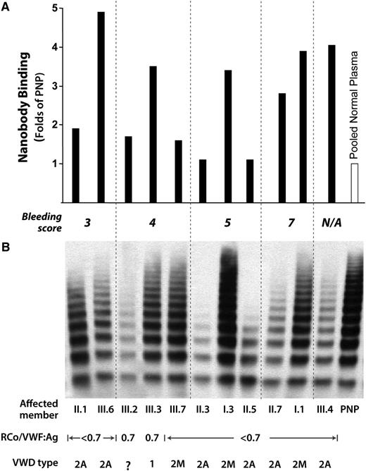 Figure 2. Phenotypic heterogeneity among the affected family members. (A) Nanobody binding. Binding of the AU/VWFa-11 nanobody to plasma VWF was higher in most of the affected family members than in pooled normal plasma (PNP), and binding varied considerably among the affected individuals. (B) VWF multimers. Multimer patterns of plasma VWF varied significantly among the affected individuals; whereas some samples lack both high- and intermediate-sized molecular-weight forms, others showed normal multimer patterns. Individual III.4 was an infant and a bleeding survey was not completed for this subject. For each of the VWD patients, 1 μL of plasma was loaded; for the PNP control, 0.5 μL of plasma was loaded.