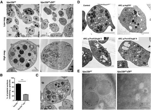 Figure 2. Ultrastructural analysis of Vps33bfl/fl-ERT2 platelets reveals an α-granule deficiency. (A) Representative transmission electron micrographs of platelets from Vps33bfl/fl (left panels) and Vps33bfl/fl-ERT2 (right panels) mice at low (scale bar, 1 μm) and high magnification (scale bar, 0.5 μm). Images were obtained using a Tecnai G2 Spirit TEM. (B) Percentage of α-granule containing platelets per ultrathin section (70 to 90 nm) in Vps33bfl/fl and Vps33bfl/fl-ERT2 mice (n = 200 platelets per genotype). (C) Platelets containing small granules were observed in TEM from Vps33bfl/fl-ERT2 mice. Those platelets were devoid of α-granules. Scale bar, 0.5 μm. (D) Representative transmission electron micrographs of an ARC patient with a VIPAS39 mutation (p.Arg270*, top right panel) and 2 ARC patients with VPS33B mutations (p.Pro412Argfs*7 or p.Pro147Argfs*4, bottom left and right panel respectively). Small α-granule–like structures are shown in white arrowheads. Scale bar, 1 μm. (E) Immunogold labeling (IEM) using the Tokuyasu method for the presence of VWF (10 nm gold) in platelets from Vps33bfl/fl (left panel) and Vps33bfl/fl-ERT2 (right panel) mice. Scale bar, 200 nm. All values are mean ± SD. ***P < .001. α, α-granule; δ, δ-granule; G, α-granule-like structure; M, mitochondrion.