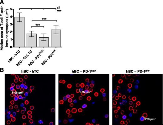 Figure 5. Immune synapse formation between B and T cells according to PD-1 expression. Spleen cells from mice with CLL after AT (n = 5) and age-matched WT mice (n = 3) were debulked of CLL/B cells using magnetic beads; stained for CD3, 8, and PD-1; and flow-sorted into CD3+CD8+, CD3+CD8+PD-1high, and CD3+CD8+PD-1low cells. Cells from WT mice were sorted on CD3+CD8+ only. (A) Comparison of median areas of immune synapses (µm2) between normal B and CD8+ T cells (hBC-hTC), normal B cells and CLL T cells (hBC-CLL TC), normal B cells and PD-1lowCD8+ T cells (hBC-PD-1low), and normal B cells and PD-1highCD8+ T cells (hBC-PD-1high). ns, nonsignificant. *P < .05, **P < .001, ***P < .0001. (B) Representative confocal images of synapses taken with a ×63 objective between hBC-hTC, hBC- PD-1high, and hBC-PD-1low cells. Blue, amino-4-chloromethylcoumarin–labeled B cells; red, rhodamine phalloidin staining actin cytoskeleton.