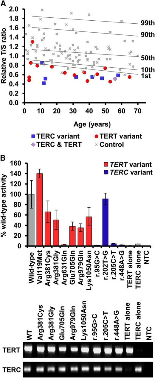Figure 2. Telomere lengths of patients and telomerase activity of selected variants. (A) Telomere lengths were measured by MM-qPCR and expressed as a T:S ratio for probands and 99 normal controls. Percentiles for the normal controls are indicated. All samples were normalized to a reference. (B) Telomerase activity was measured in WI38-VA13 cells ectopically expressing the stated telomerase variant. Activity was calculated as a percentage of wild-type levels, measured using the TRAP. Less than 5% activity is considered LOF. RT-PCR products demonstrate expression of wild-type and mutant TERC and TERT mRNA. Bars show standard error of mean of duplicate readings from 2 independent experiments. MM-qPCR, monochrome multiplex quantitative PCR; mRNA, messenger RNA; NTC, no template control; RT-PCR, reverse transcription PCR.