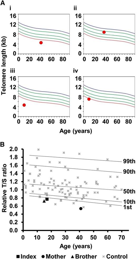 Figure 4. Telomere lengths in families 8 and 23. (A) Lymphocyte telomere lengths in family 8 measured by flow-FISH. (i) Father of the index, asymptomatic with TERC variant r.448A>G; (ii) mother of the index, asymptomatic, wild type for TERC; (iii) index case with TERC variant r.448A>G; (iv) sister of the index, affected, wild type for TERC. Curved lines represent 99th, 90th, 50th, 10th, and first percentiles. (B) Telomere lengths of family 23 measured by MM-qPCR. Telomere lengths are expressed as a T:S ratio for the index case, his mother (heterozygous for TERT variant) and his brother (wild type for TERT). These are compared with 99 normal controls (as in Figure 2A). Percentiles for the normal controls are indicated. All samples were normalized to a reference.