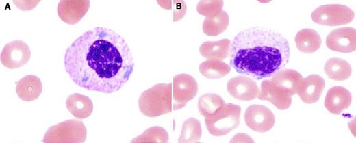 A 63-year-old man was discovered to have abnormal laboratory results after routine blood work and was diagnosed with acute myeloid leukemia with myelodysplasia-related changes (AML-MRC). After bone marrow confirmation, the patient was treated with chemotherapy followed by haploidentical hematopoietic stem cell transplantation. Tacrolimus therapy was then initiated for prevention of graft-versus-host disease. A follow-up peripheral blood smear (PBS) showed numerous hypolobated neutrophils with a unique morphology of round to oval single nucleus, clumped chromatin, adequate cytoplasmic granules, and occasional Döhle bodies, which suggested relapse of the disease (panels A-B, Wright-Giemsa stain; original magnification ×1000). Meanwhile, bone marrow evaluation was unremarkable, and engraftment studies showed complete donor engraftment. Four months later, when tacrolimus therapy was discontinued, subsequent PBSs showed return of normal neutrophil morphology. / Pseudo–Pelger-Huët anomaly (PPHA) is a marker of granulocytic dysplasia conventionally seen in myelodysplastic syndrome (MDS). It can also be seen with use of certain drugs such as immunosuppressants. The literature shows that drug-induced PPHA tends to have monolobated neutrophils with a single ovoid nucleus, unlike MDS, which is classically characterized by bilobed neutrophils. This morphologic difference can be exploited in the diagnostic dilemma of MDS, AML-MRC, and drug-induced PPHA.