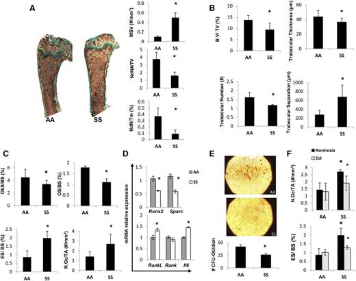 Figure 1. Sickle cell mice display bone impairment, increased osteoclast activity, and suppression of osteoblastogenesis. Beneficial effects of zoledronic acid (Zol) on osteoclast activity in sickle cell mice. (A) Quantitative histomorphometry of the distal femur of healthy (AA) and sickle cell (SS) mice. Upper panel: representative undecalcified section of distal femur stained with trichrome Goldner’s stain. Lower panel: MSV, marrow star volume; NdN/TV, node number/tissue volume; NdN/Tm, node to termini ratio. Data are shown as mean ± standard deviation (SD) (n = 6); *P < .05 compared with healthy mice. (B) Bone volume (BV)/tissue volume (TV), trabecular thickness, trabecular number, and trabecular separation measured by Bone Explora Nova 3.5 image analyzer. Data are shown as mean ± SD (n = 6); *P < .05 compared with healthy mice. (C) ObS/ BS, osteoblast surface/bone surface; OS/BS, osteoid surface/bone surface; N.Oc/TA, osteoclast number/tissue area; ES/BS, Erosion surface/bone surface. Data are shown as mean ± SD (n = 6); *P < .05 compared with healthy mice. (D) Real-Time PCR analysis of Runx2, Sparc, RankL, Rank, and Il6. Data are shown as mean ± SD (n = 6); *P < .05 compared with healthy mice. (E) To assess the number of osteoprogenitors, bone marrow–derived cells were cultured in vitro under osteogenic differentiation conditions. The CFU-Ob obtained from the MSCs of AA and SS mice were stained by alizarin red (upper panel) and quantified (#CFU-Ob/dish) (lower panel); data are shown as mean ± SD (n = 3; P < .05 AA vs SS). (F) ES/BS, erosion surface/bone surface; N.Oc/TA, osteoclast number/tissue area in AA and SS mice with and without Zol treatment (100 μg/kg IP). Data are shown as mean ± SD (n = 6); *P < .05 compared with healthy mice; °P < .05 compared with vehicle-treated mice.