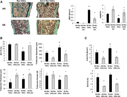 Figure 4. Recurrent hypoxia/reoxygenation (H/R) stress mimicking acute vaso-occlusive crisis (VOCs) worsens bone structure in sickle cell mice. (A) Quantitative histomorphometry of the distal femur of healthy (AA) and sickle cell (SS) mice exposed to recurrent (Rec) acute VOCs without and with Zol treatment. Left panel: representative undecalcified section of distal femur stained with trichrome Goldner’s stain. Right panel: MSV, marrow star volume; NdN/TV, node number/tissue volume; NdN/Tm, node to termini ratio. Data are shown as mean ± SD (n = 6); P < .05 compared with healthy mice; °P < .05 compared with vehicle-treated mice. (B) Bone volume (BV)/tissue volume (TV), trabecular thickness, trabecular number, and trabecular separation in healthy (AA) and sickle cell (SS) mice exposed to recurrent (Rec) acute VOCs without and with Zol treatment. (C) N.Oc/TA, osteoclast tumber/tissue area; ES/BS, erosion surface/bone surface in AA and SS mice exposed to recurrent (Rec) acute VOCs without and with Zol. Data are shown as mean ± SD (n = 6); *P < .05 compared with healthy mice; °P < .05 compared with vehicle-treated mice.
