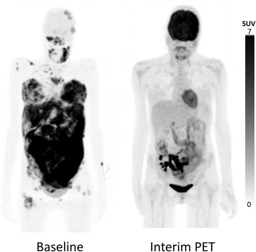 Figure 1. Maximum-intensity projection 18F-FDG–PET/CT images. Baseline image showed multiple supra- and infradiaphragmatic nodal lesions and extranodal lesions in breast, intestines, and bone marrow (left); 18F-FDG–PET/CT after 4 cycles of therapy showed a complete metabolic response in all nodal and extranodal lesions, with the exception of limited residual hypermetabolic lesions in the intestinal tract adjacent to the kidney transplant in the right iliac fossa (right). 18F, radionuclide fluorine 18; FDG, fluorodeoxyglucose; PET, positron emission tomography; CT, computed tomography.