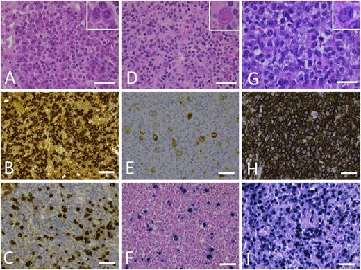 Figure 2. Morphologic spectrum of PTLD. (A-C) PTLD, early lesion, plasmacytic hyperplasia. (A) In a preserved underlying architecture, there is a proliferation of small reactive plasma cells (inset). Immunohistochemical staining against κ (B) and λ (C) light chains shows the polytypic character of the plasma cells. (D-F) PTLD, polymorphic. (D) Lymph node architecture is effaced by a polymorphic proliferation of B cells of variable size, shape, and degree of transformation (HRS-like cell shown in inset), which are admixed with numerous small lymphocytes, plasma cells, eosinophils, and histiocytes. (E) Immunohistochemical staining against CD20 shows membranous and often Golgi-type expression in the B blasts. (F) Epstein-Barr virus–encoded RNA in situ hybridization shows nuclear positivity not only in the HRS-like cells but also in a variety of B cells. (G-I) PTLD, monomorphic, EBV+ DLBCL. (G) Monotonous proliferation of large transformed B cells (inset) with an infiltrative growth pattern and mitotic activity. (H) Diffuse CD20 expression of the infiltrate corresponding to the B-cell phenotype. (I) Most cells are EBV+, as seen in this Epstein-Barr virus–encoded RNA in situ hybridization. Images were taken with a Leica DFC290. Bars represent 50 µm. Original magnification 630×. Hematoxylin and eosin stain. HRS, Hodgkin/Reed-Sternberg.