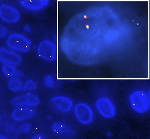 Figure 1. FISH targeting the ETV3-NCOA2 gene fusion in ICH. Red probe for ETV3 in chromosome 1 and green probe for NCOA2 in chromosome 8. ETV3-NCOA2 gene fusion (yellow) present in paraffin embedded tissue taken from patient 2 and patient 1 (inset).