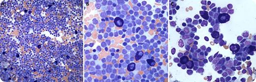 An asymptomatic 66-year-old woman presented with an elevated total protein of 9.1 g on routine blood work. Serum protein electrophoresis showed an immunoglobulin A (IgA) κ (kappa) M-spike measuring 3570 mg/dL with depression of immunoglobulins M and G (IgM and IgG). Renal function and calcium level were normal. Twenty-four–hour urine protein electrophoresis detected a faint band, too low to quantify. Lytic lesions or hepatosplenomegaly were absent. Marrow biopsy revealed a small lymphocytic infiltrate with scattered mast cells. Flow cytometry detected clonal κ-restricted B cells (CD20+CD5 subset+) and plasma cells (CD56−CD38++). A diagnosis of IgA-positive lymphoplasmacytic lymphoma was made. Lymphoplasmacytic lymphoma with IgM monoclonal gammopathy is characteristic of Waldenström macroglobulinemia. Rarely (as in the current case), lymphoplasmacytic lymphoma is associated with IgG or IgA monoclonal gammopathy. Rituximab treatment initially led to a decline in serum-free light chains. However, a subsequent rise led to ibrutinib treatment. Follow-up marrow biopsy was hypercellular with a diffuse lymphoplasmacytic infiltrate. Panels A-C (marrow aspirate smears) illustrate the predominant lymphoplasmacytic infiltrate with a prominent admixture of reactive mast cells, which were positive for CD117 and mast cell tryptase and negative for CD2 and CD25 (neoplastic markers). Panel A shows scattered mast cells with numerous lymphoplasmacytic cells. In panel B, higher magnification shows 4 reactive mast cells (with deeply basophilic granules). Panel C shows lymphoplasmacytic cells with 7 mast cells (with deeply basophilic granules). Original magnifications: A, ×100; B-C, ×200. A-C, Wright-Giemsa stain. / Reactive mast cells are often seen in lymphoplasmacytic lymphoma and have rarely been reported in chronic lymphocytic leukemia and marginal zone lymphoma.