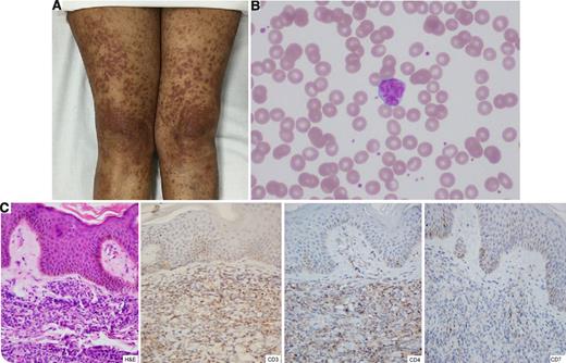 A 53-year-old woman from the Pacific region of Colombia presented with a 6-month history of pruritic papules that coalesced to form plaques in the extremities (panel A). She denied weight loss, fever, or diaphoresis. No palpable lymphadenopathy or hepatosplenomegaly was present. Laboratory examination revealed an elevated lymphocyte count of 6.2 × 109/L (reference range, 1.0-3.0 × 109/L). Calcium level was normal, whereas lactate dehydrogenase was slightly increased. Lymphocytes with flower-shaped nuclei (panel B; Wright stain, ×100) were seen in the peripheral blood smear. The immunophenotype of the cells was positive for CD3, CD4, and CD25 (strong), whereas it was negative for CD7. A skin biopsy exhibited infiltration by lymphoid cells that showed positive staining for CD3 and CD4, with loss of CD7 (panel C; hematoxylin and eosin stain, ×40, and immunohistochemical stain, ×40). Serological testing for human T-lymphotropic virus 1 (HTLV-1) was positive. A diagnosis of adult T-cell leukemia/lymphoma (ATLL) was made and treatment with interferon-α and zidovudine was started. / ATLL is a lymphoid malignancy closely associated with the oncogenic HTLV-1. This infection is endemic on the Pacific coast of Colombia and is usually acquired during early childhood by vertical transmission. Clinical course is variable, and skin and peripheral blood involvement is common in the chronic leukemic variant.