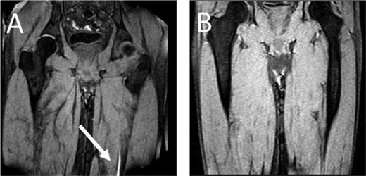Figure 1. MRDTI of patient from case. (A) The white arrow indicates the fresh thrombus in the popliteal vein of the right leg. For contrast, B depicts the MRDTI of a patient with residual thrombosis in the left popliteal and femoral vein: no DTI signal is present.