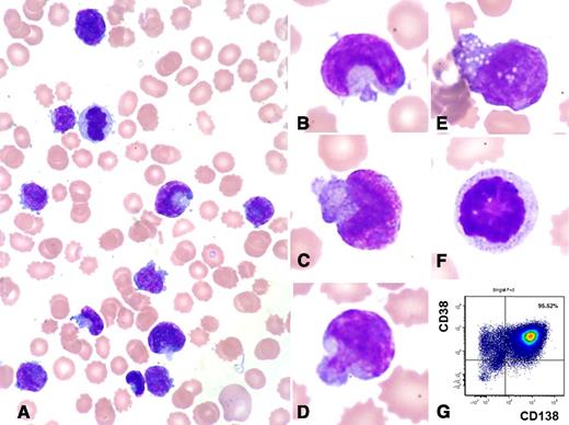 This peripheral blood smear is from a 72-year-old woman, taken several hours before she died of recurrent plasma cell myeloma and newly developed secondary plasma cell leukemia. Her white blood cell count increased from 39.5 × 103/μL to 233.2 × 103/μL in 28 hours. The peripheral blood smear shows marked leukocytosis with numerous small- to medium-sized bizarre-looking cells (95% of white blood cells) (panels A-E), which were not seen in her initial bone marrow aspirate. These cells have pleomorphic nuclear shapes such as a fish mouth, a mushroom, or a moon. All cells have scant pale cytoplasm, and some have cytoplasmic vacuoles. Mitotic figures are identified (panels A and F). / Despite the unusual cellular morphology, flow cytometric analysis confirmed these cells to be aberrant plasma cells (positive for CD38, CD138, partial CD56, and κ light chain, and negative for CD45, CD19, CD20, CD28, CD117, and λ light chain) (panel G). Her initial cytogenetics study showed a complex karyotype: 45∼46,XX,+1,add(1)(p13),der(3)t(3;11)(q29;q13),t(11;14)(q13;q32),+14, del(14)(q24). Fluorescence in situ hybridization reported monosomy 13, t(11;14) IgH/cyclinD1 translocation, CSK1B gene amplification, and TP53 gene deletion. Cytogenetics was not performed during her last admission. Her initial serum lactate dehydrogenase level was normal, but her last serum lactate dehydrogenase level was 30 489 IU/L (normal, 313-618 IU/L). Her initial and last serum β2-microglobulin levels were 9.5 and 7.4 mg/L (normal, 0.8-2.3), respectively. This case highlights the broad morphologic spectrum of plasma cell myeloma/leukemia.